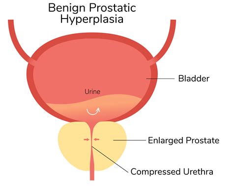 Overcoming the Emotional Struggles of Prostate Enlargement